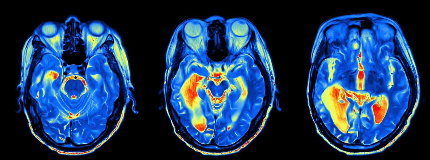 Oxford Brain Diagnostics wins funding from the National Institute for Health Research (NIHR) to test Alzheimer’s diagnostic in NHS