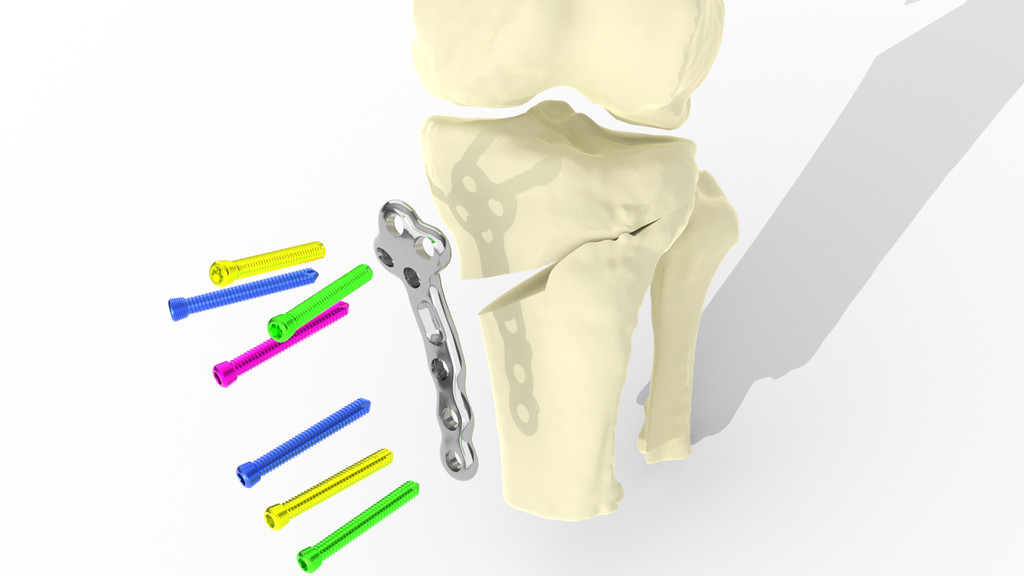 Precision medicine SME secures Knowledge Transfer Partnership to create personalised knee implants